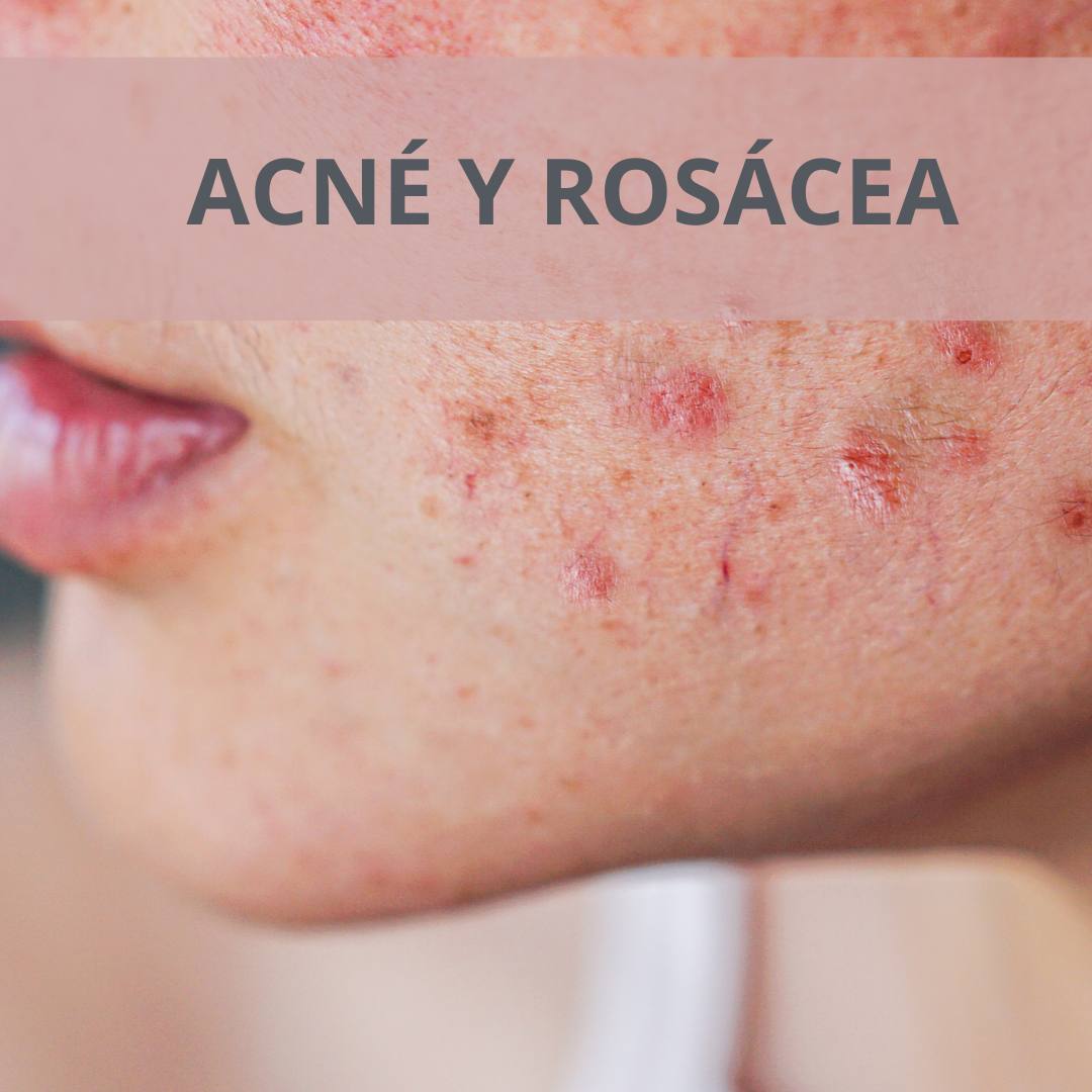 Acné y rosácea