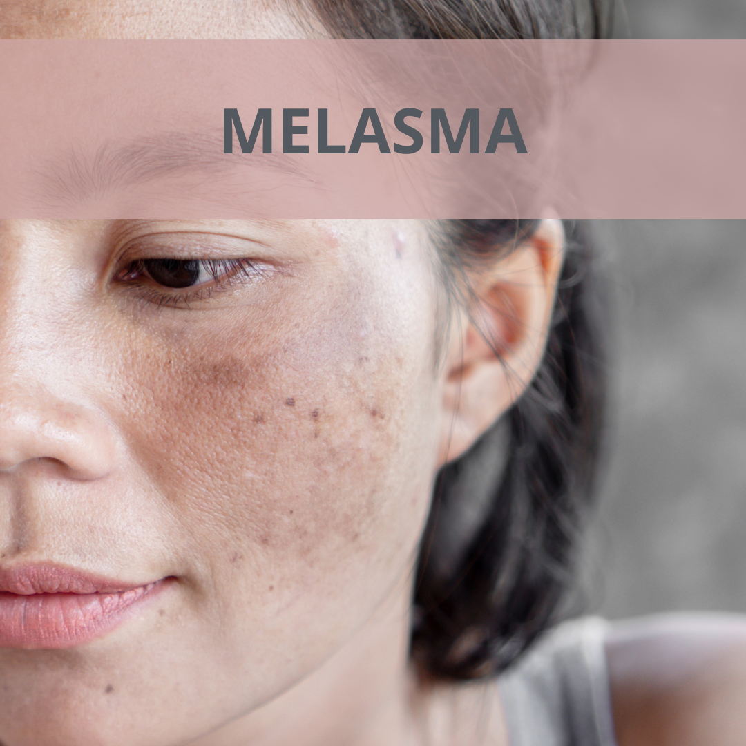 Melasma